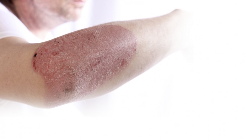 Plaque Psoriasis