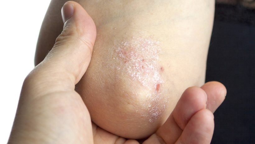 Plaque Psoriasis – (ME3183-3)