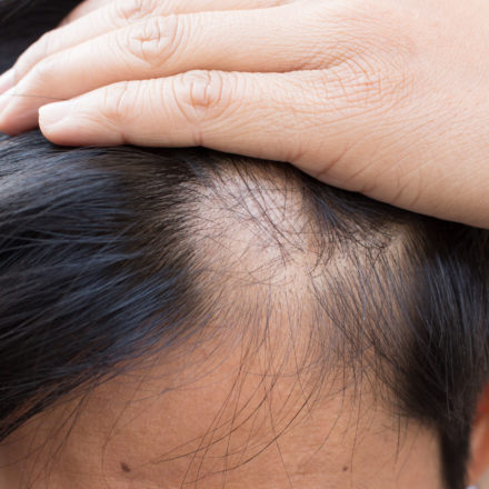 Treatment of Alopecia Areata (B7981015)