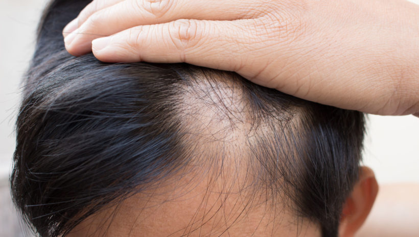 Alopecia Areata – M23-716